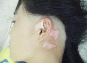 发展期的白癜风有什么症状