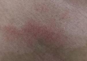 白癜风的治疗好方法，你知道多少