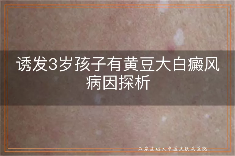 诱发3岁孩子有黄豆大白癜风病因探析