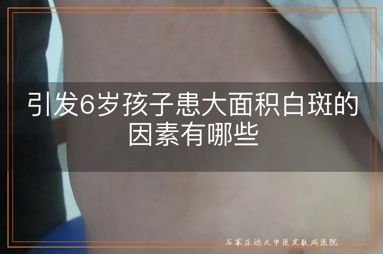 引发6岁孩子患大面积白斑的因素有哪些