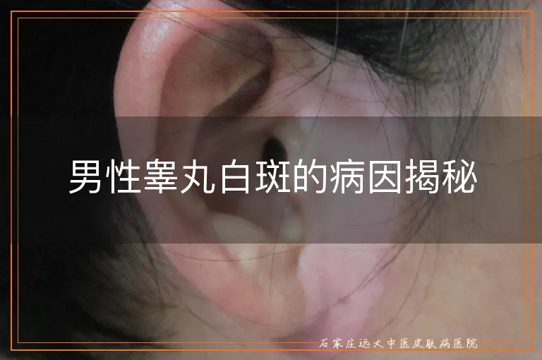 男性睾丸白斑的病因揭秘