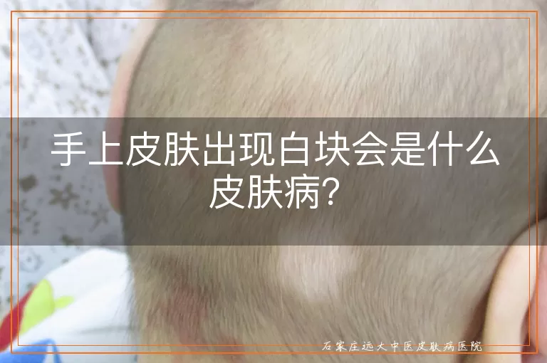 手上皮肤出现白块会是什么皮肤病？