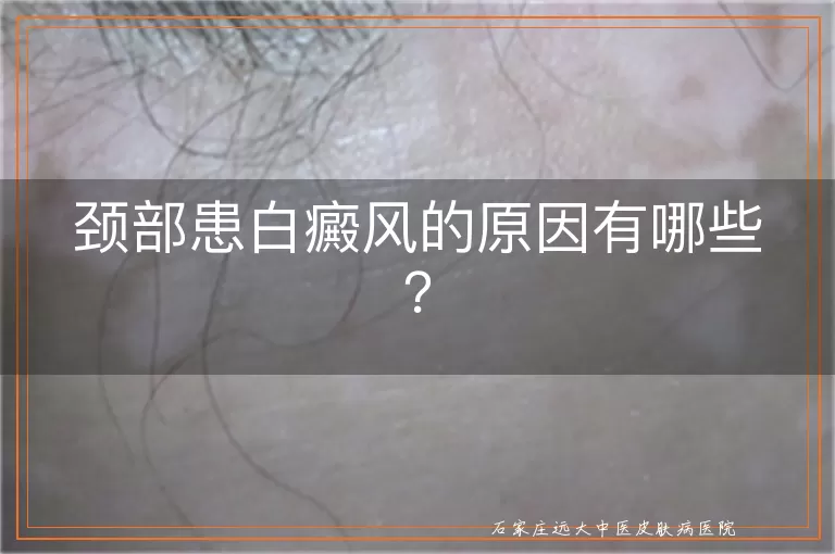 颈部患白癜风的原因有哪些？