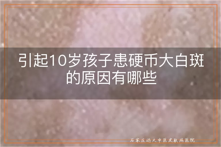 引起10岁孩子患硬币大白斑的原因有哪些
