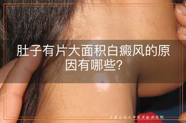 肚子有片大面积白癜风的原因有哪些？