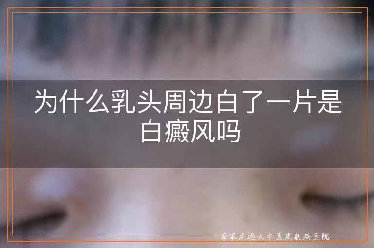 为什么乳头周边白了一片是白癜风吗