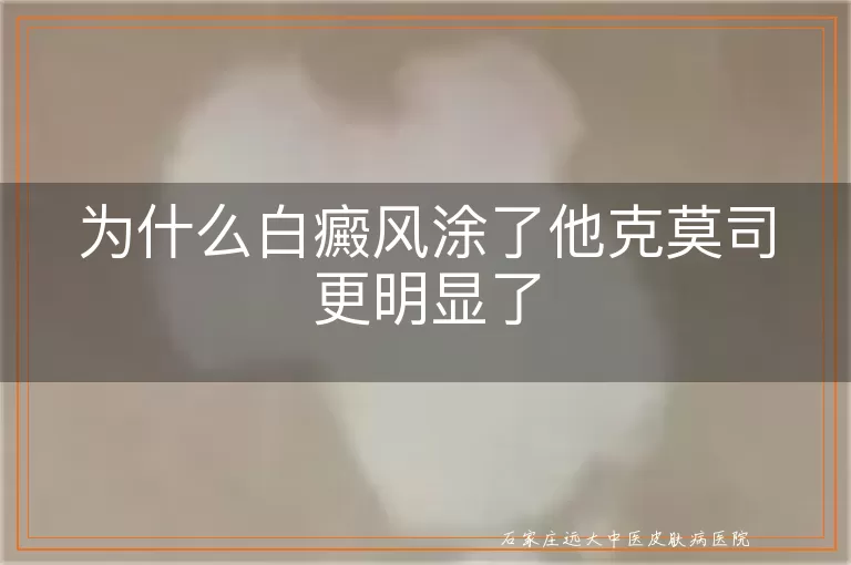 为什么白癜风涂了他克莫司更明显了