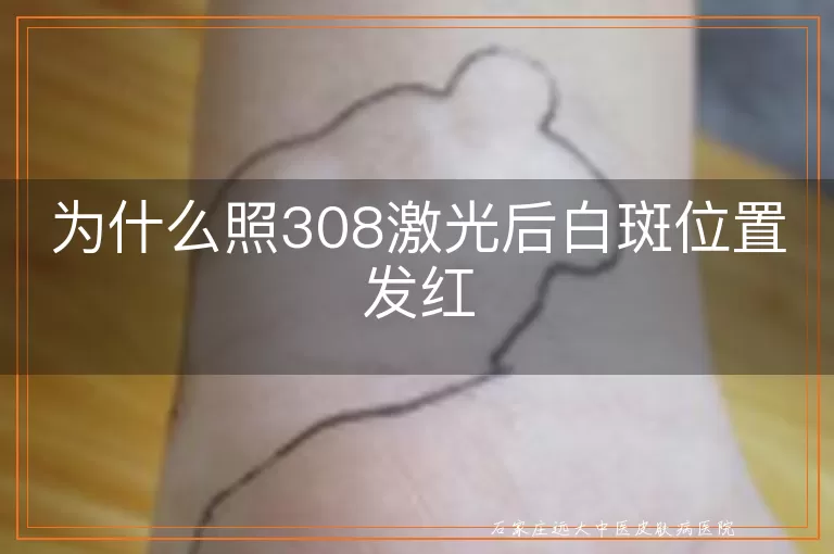 为什么照308激光后白斑位置发红