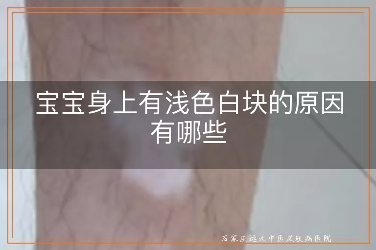 宝宝身上有浅色白块的原因有哪些