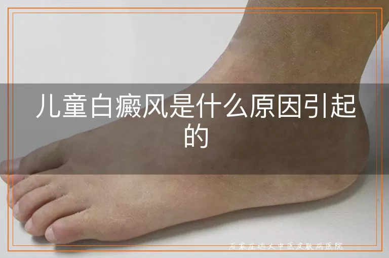 儿童白癜风是什么原因引起的