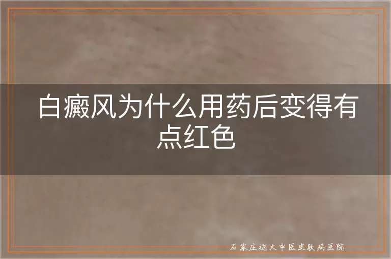 白癜风为什么用药后变得有点红色