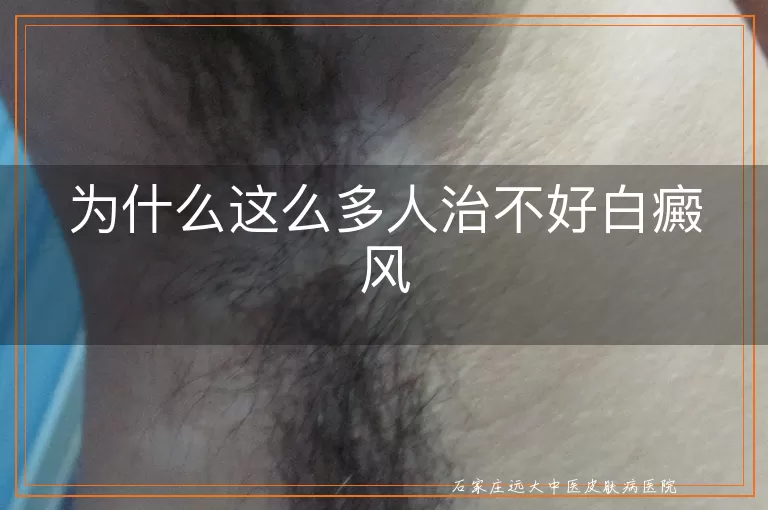 为什么这么多人治不好白癜风