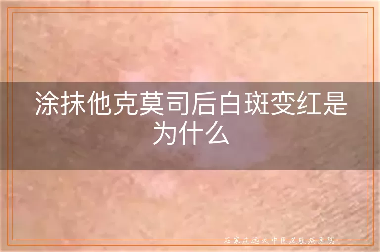涂抹他克莫司后白斑变红是为什么