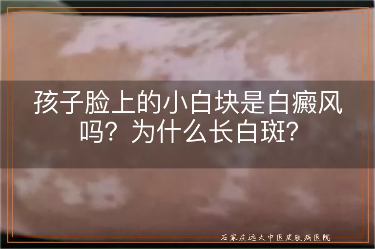 孩子脸上的小白块是白癜风吗？为什么长白斑？