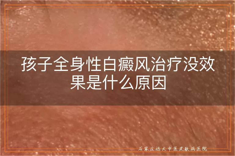 孩子全身性白癜风治疗没效果是什么原因