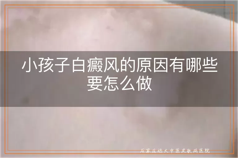 小孩子白癜风的原因有哪些要怎么做