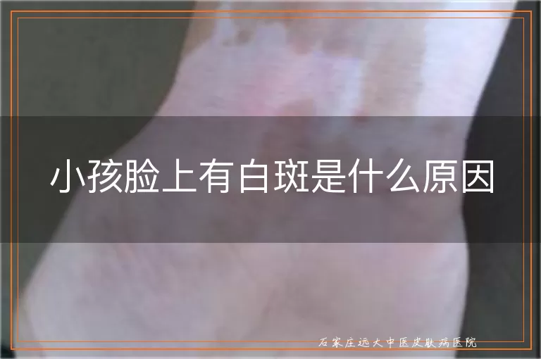 小孩脸上有白斑是什么原因