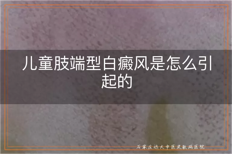 儿童肢端型白癜风是怎么引起的