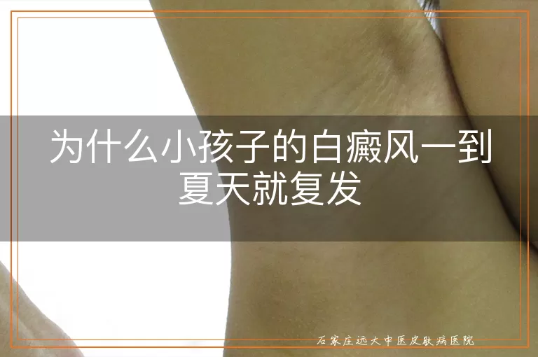 为什么小孩子的白癜风一到夏天就复发