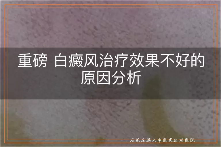 重磅 白癜风治疗效果不好的原因分析