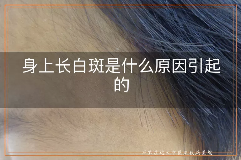 身上长白斑是什么原因引起的