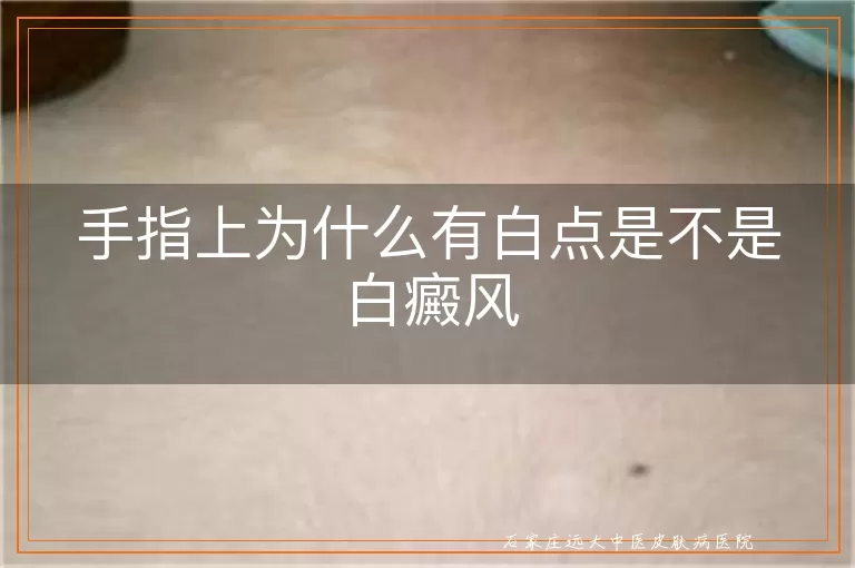 手指上为什么有白点是不是白癜风