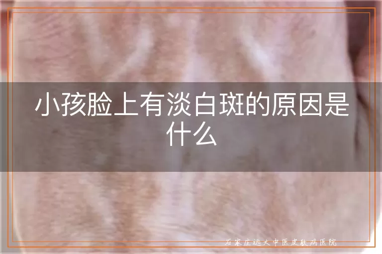 小孩脸上有淡白斑的原因是什么