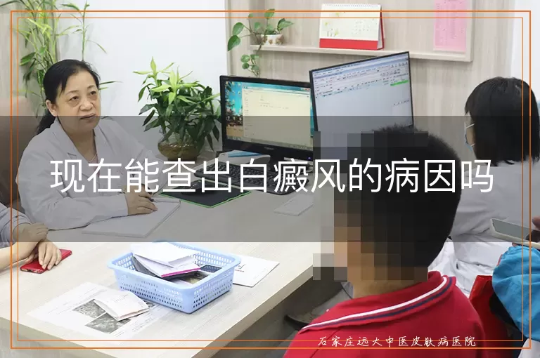 现在能查出白癜风的病因吗