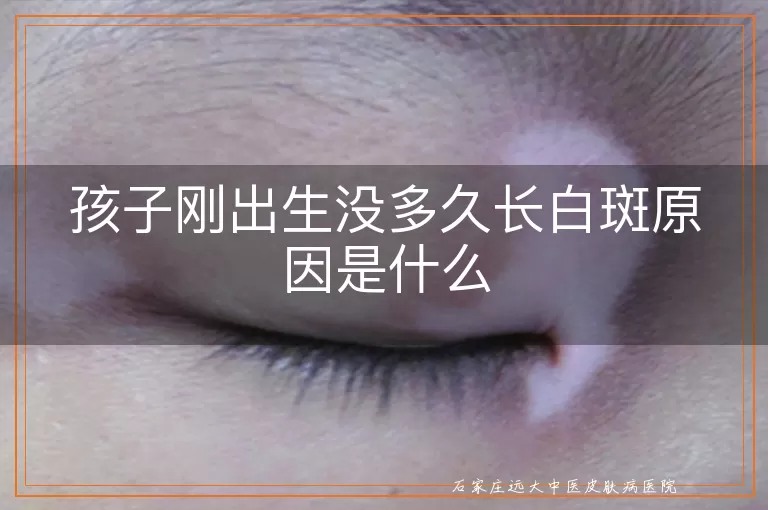 孩子刚出生没多久长白斑原因是什么