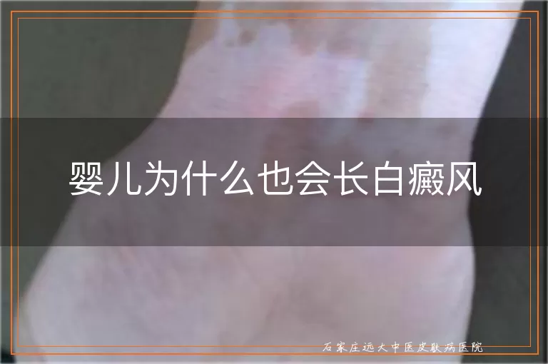 婴儿为什么也会长白癜风