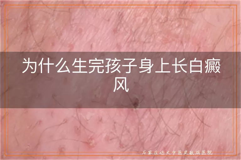 为什么生完孩子身上长白癜风