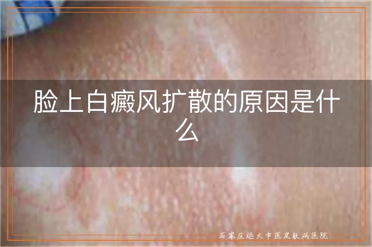 脸上白癜风扩散的原因是什么