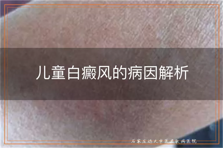 儿童白癜风的病因解析