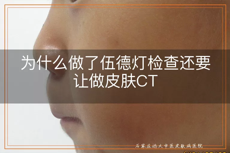 为什么做了伍德灯检查还要让做皮肤CT