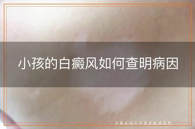 小孩的白癜风如何查明病因