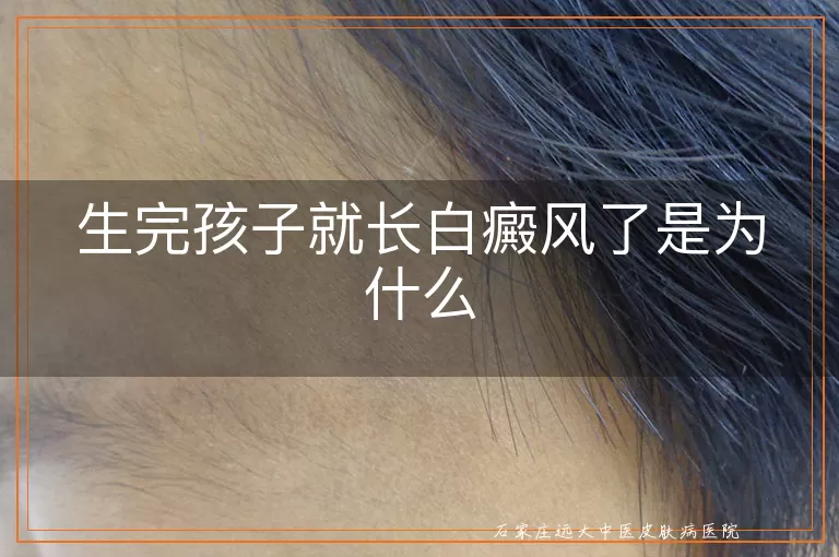 生完孩子就长白癜风了是为什么