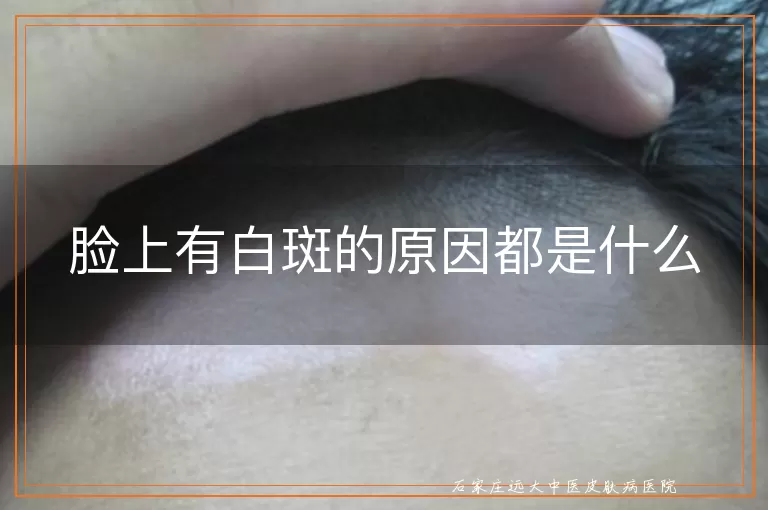 脸上有白斑的原因都是什么