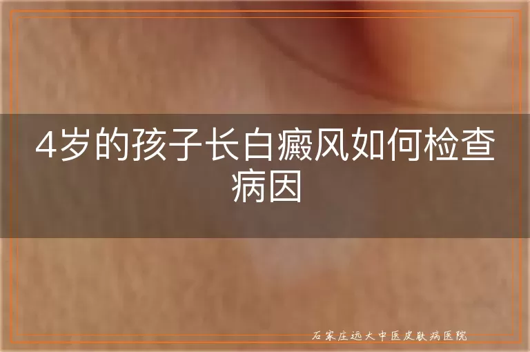 4岁的孩子长白癜风如何检查病因