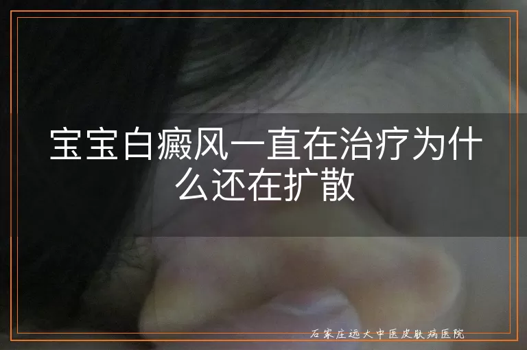 宝宝白癜风一直在治疗为什么还在扩散