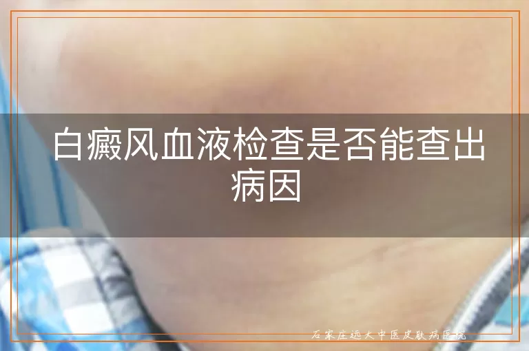 白癜风血液检查是否能查出病因