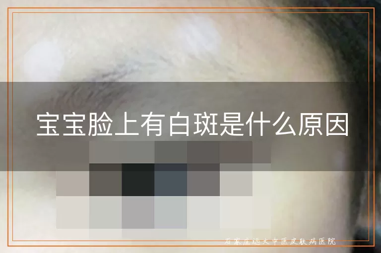 宝宝脸上有白斑是什么原因