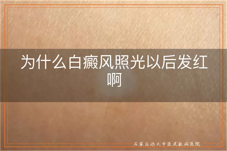 为什么白癜风照光以后发红啊