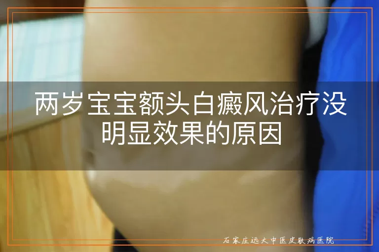 两岁宝宝额头白癜风治疗没明显效果的原因