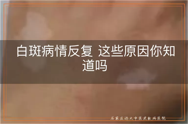 白斑病情反复 这些原因你知道吗