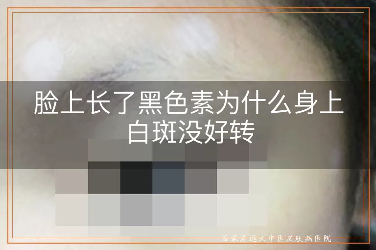 脸上长了黑色素为什么身上白斑没好转