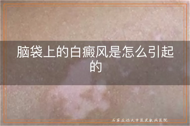 脑袋上的白癜风是怎么引起的