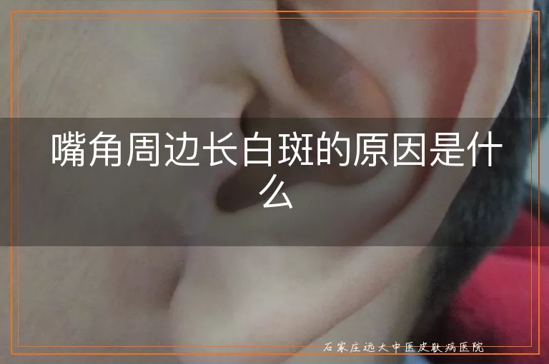 嘴角周边长白斑的原因是什么