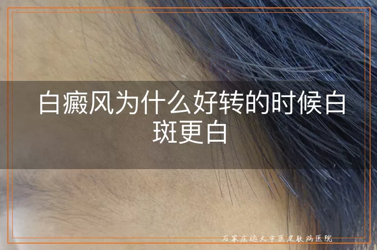 白癜风为什么好转的时候白斑更白