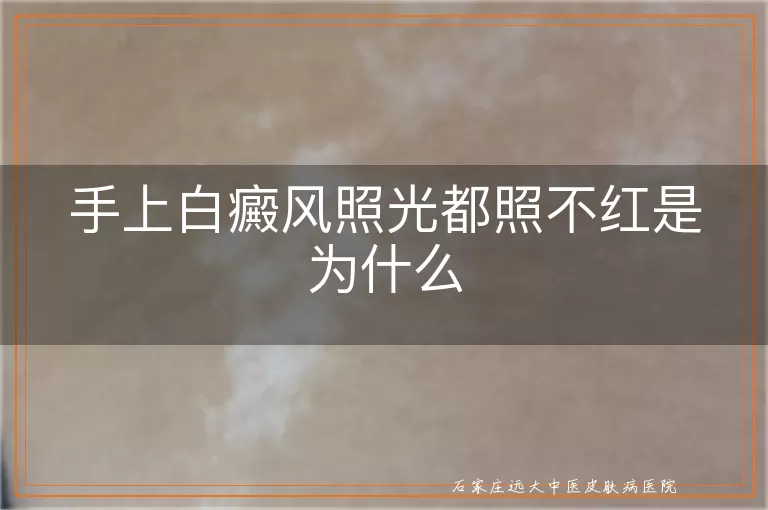 手上白癜风照光都照不红是为什么