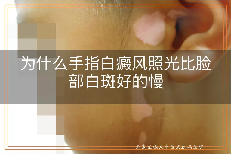 为什么手指白癜风照光比脸部白斑好的慢